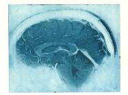 Daniel's Brain, Sagittal MRI view of a neurologist's MRI. Courtesy Elizabeth Jameson