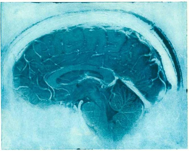 OURTESY ELIZABETH JAMESON Daniel's Brain, Sagittal MRI view of a neurologist's MRI.